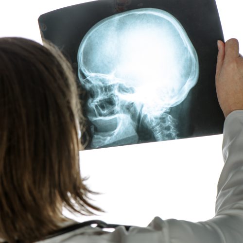 Doctor analyzing human skull x-ray screening image C1 Fracture