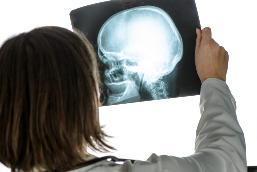 Doctor analyzing human skull x-ray screening image C1 Fracture