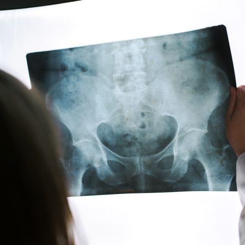 Female doctor examining pelvis x-ray in hospital office Coccygeal Pain