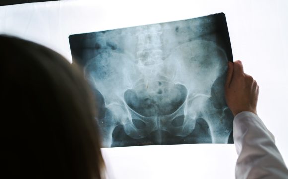 Coccygeal Pain