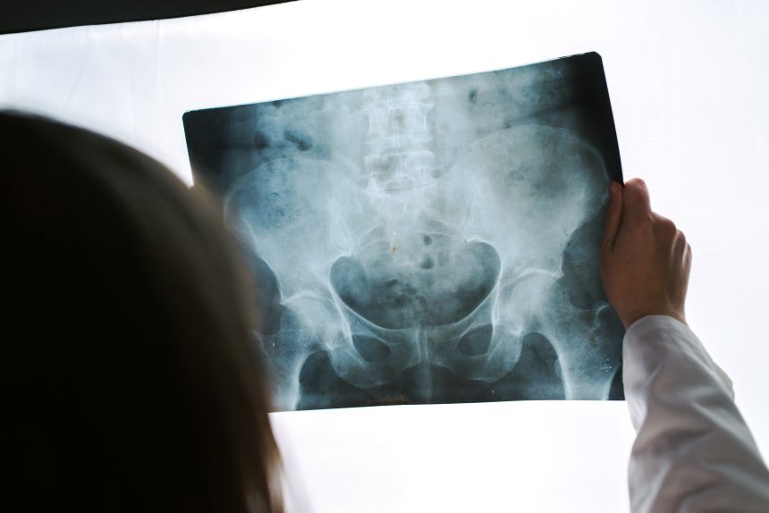 Female doctor examining pelvis x-ray in hospital office Coccygeal Pain
