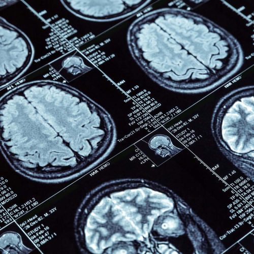 brain